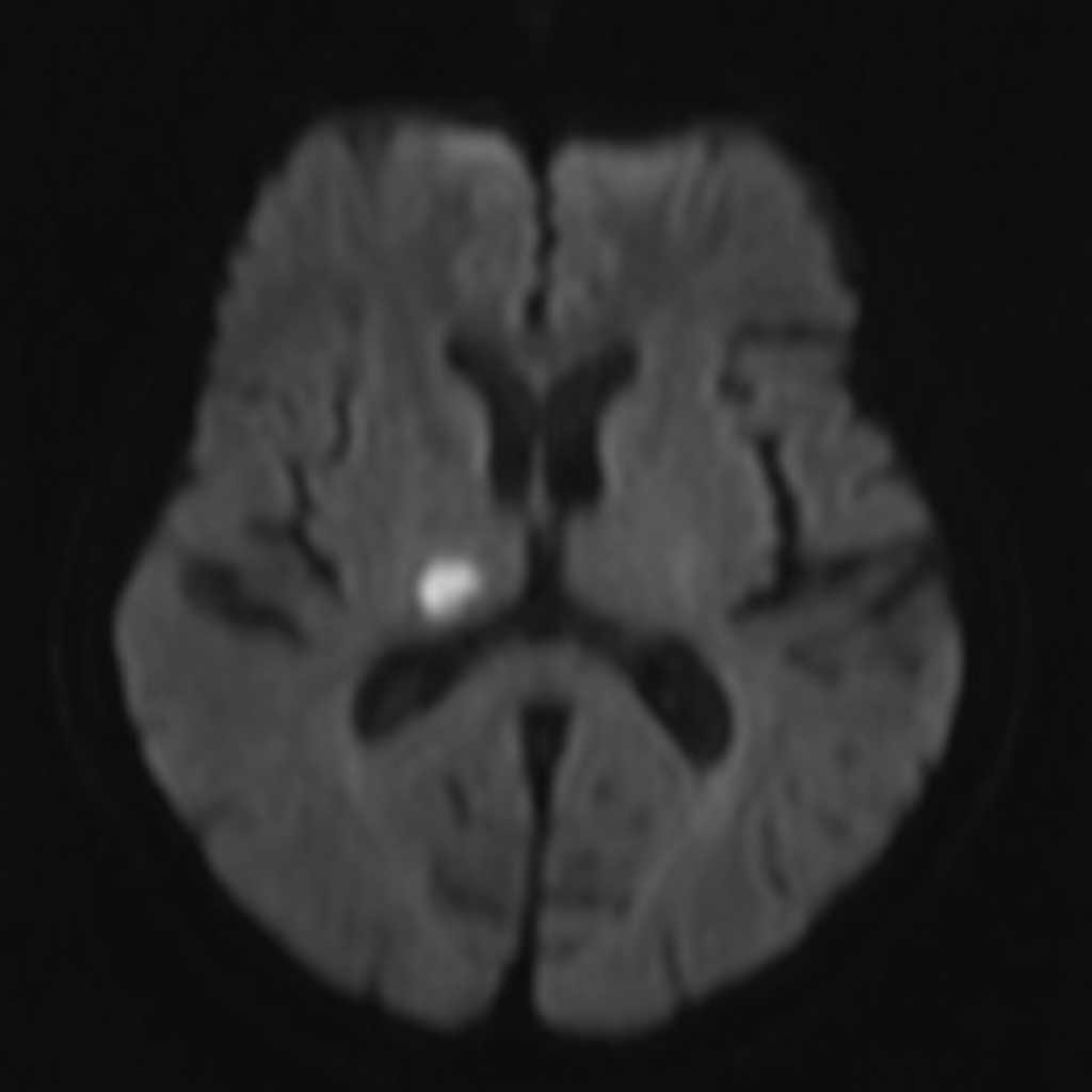 頭部MRI（拡散強調画像）